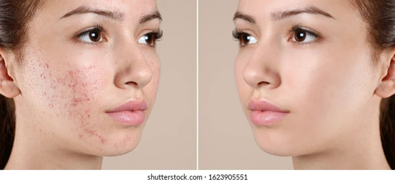 18. For Acne-Free Skin, Eating Healthly Reduces Acne