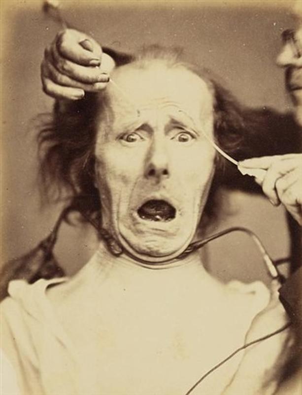 Duchenne de Boulogne using electrical probes to stimulate the facial muscles, 1862.