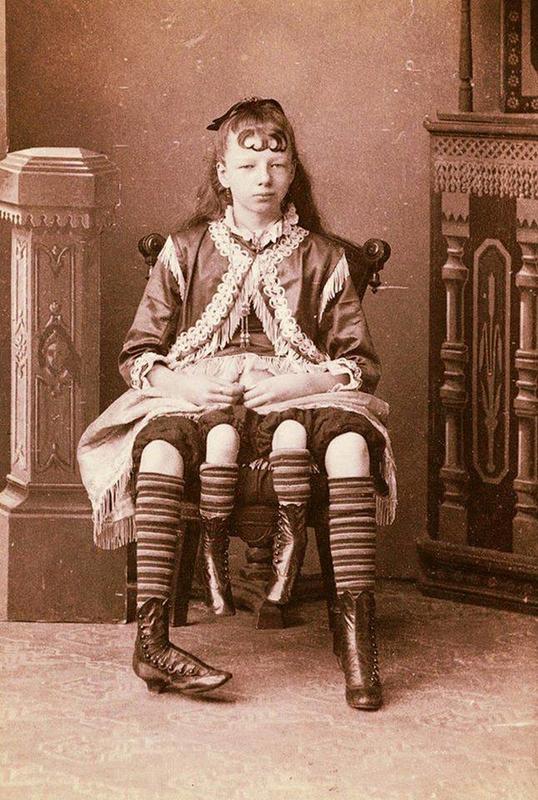 Photographed in 1880, Myrtle Corbin was born a dipygus having two separately functioning pelvises and four legs.
