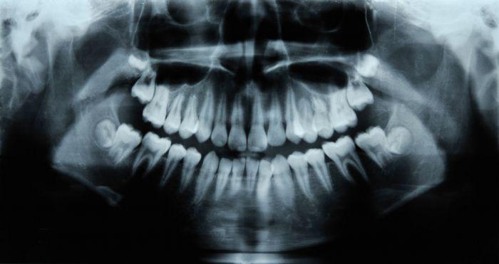 In 2019, A Seven Year OId Boy In India Complained Of A Toothache, After Examination He Was Found To Have Over 520 Extra Teeth