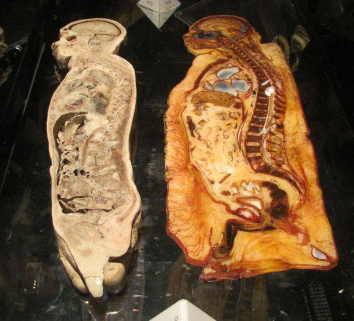 Cross Section Of Two Human Males " One Obese And The Other Fit.